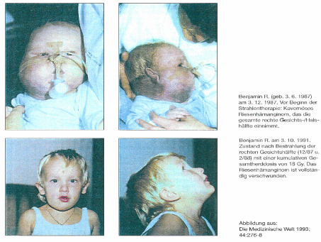 Originalabbildung mit vier Fotos vor und nach einer Strahlentherapie. Die oberen Fotos zeigen ein großes Hämangiom im rechten Gesichts- und Halsbereich; die unteren Fotos zeigen die Kontrollaufnahmen von 1991.