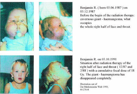 Original clinical illustration with four photographs before and after radiotherapy. The upper pair shows a large haemangioma in the right face and neck; the lower pair shows the follow-up appearance in 1991.